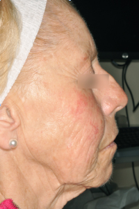 Huidpunt fractional laser